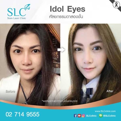 SLC Clinic - ตาสองชั้น ตาแบ๊ว ตาฝรั่ง ตาสายฝอ 02