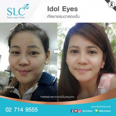 SLC Clinic - ตาสองชั้น ตาแบ๊ว ตาฝรั่ง ตาสายฝอ 06